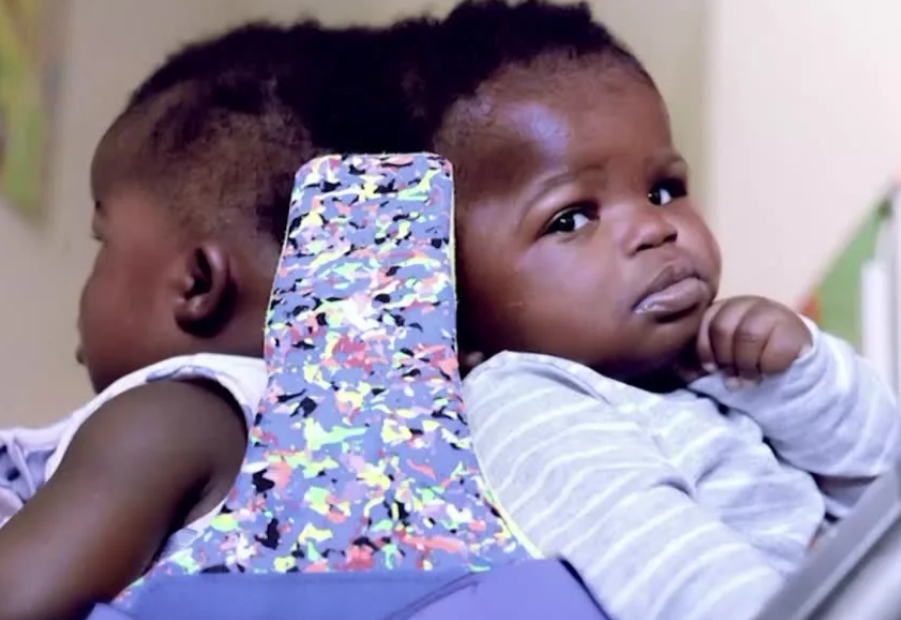 Ιταλία: Σιαμαία δίδυμα ενωμένα στο κεφάλι διαχωρίστηκαν επιτυχώς