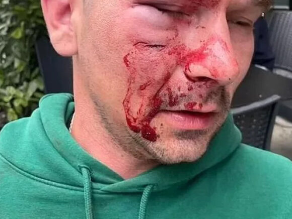 Λονδίνο: Μετανάστης ξυλοκοπήθηκε άγρια επειδή τόλμησε να ζητήσει οδηγίες από αγνώστους